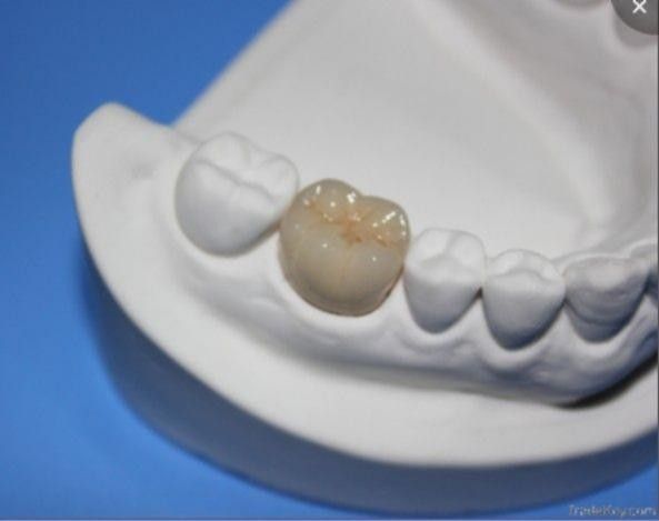 pl3375920-metal_dental_crown_with_white_tooth_like_coloration
